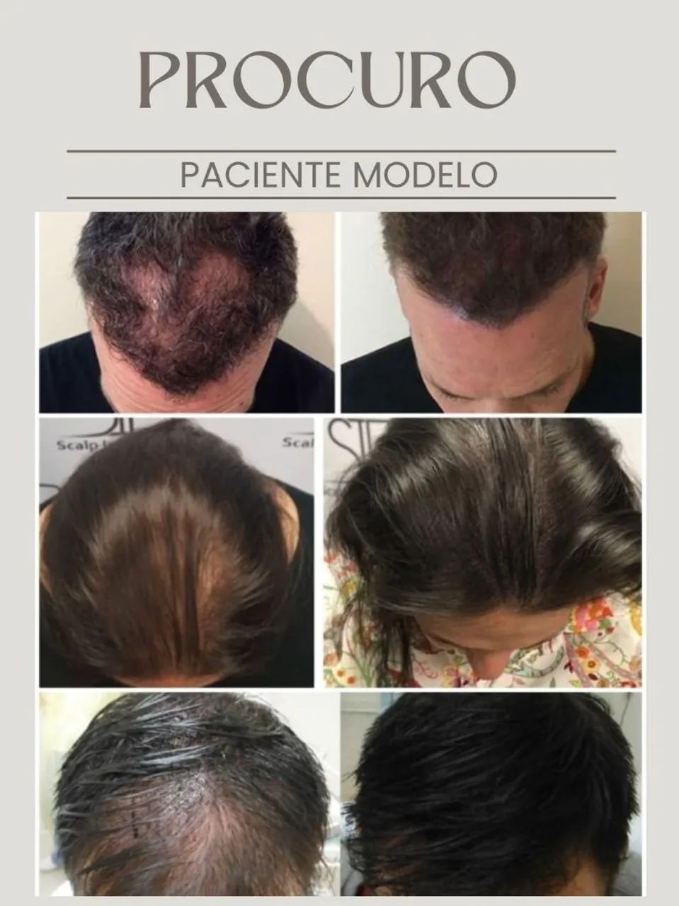 Modelo para micropigmentação Capilar