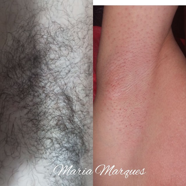 Depilação feminina e masculina - Foto 5