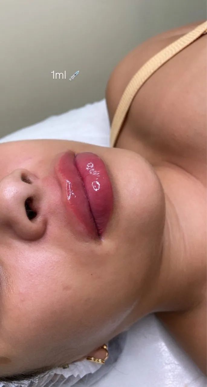 Estetica Preenchimento Labial 