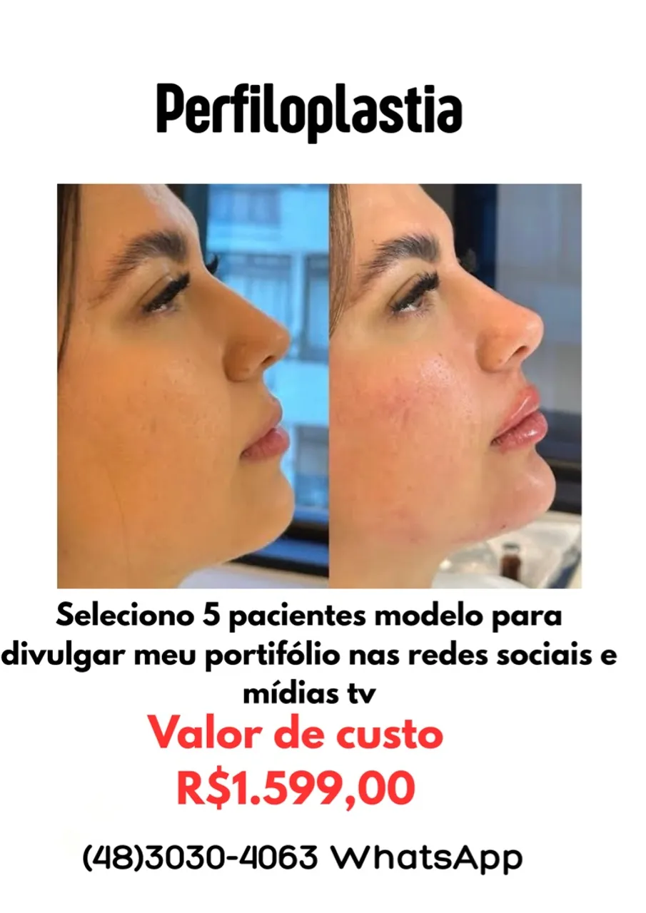 Perfiloplastia - R$1.599,00