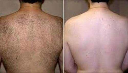 Depilação Masculina Goiânia