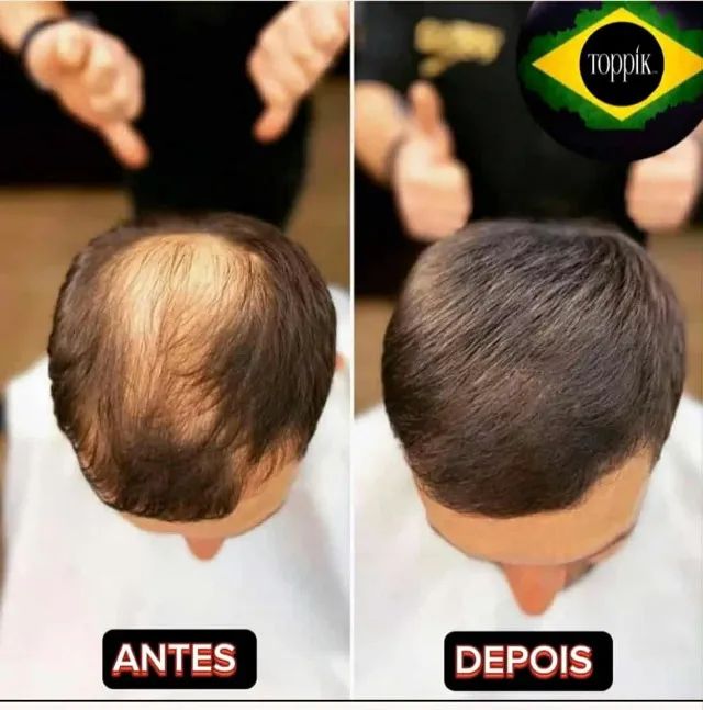 Queda de cabelo - Foto 2