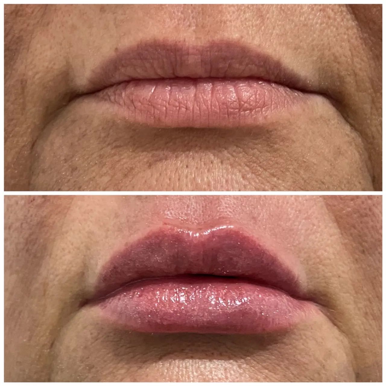 Estetica Preenchimento Labial  - Foto 4