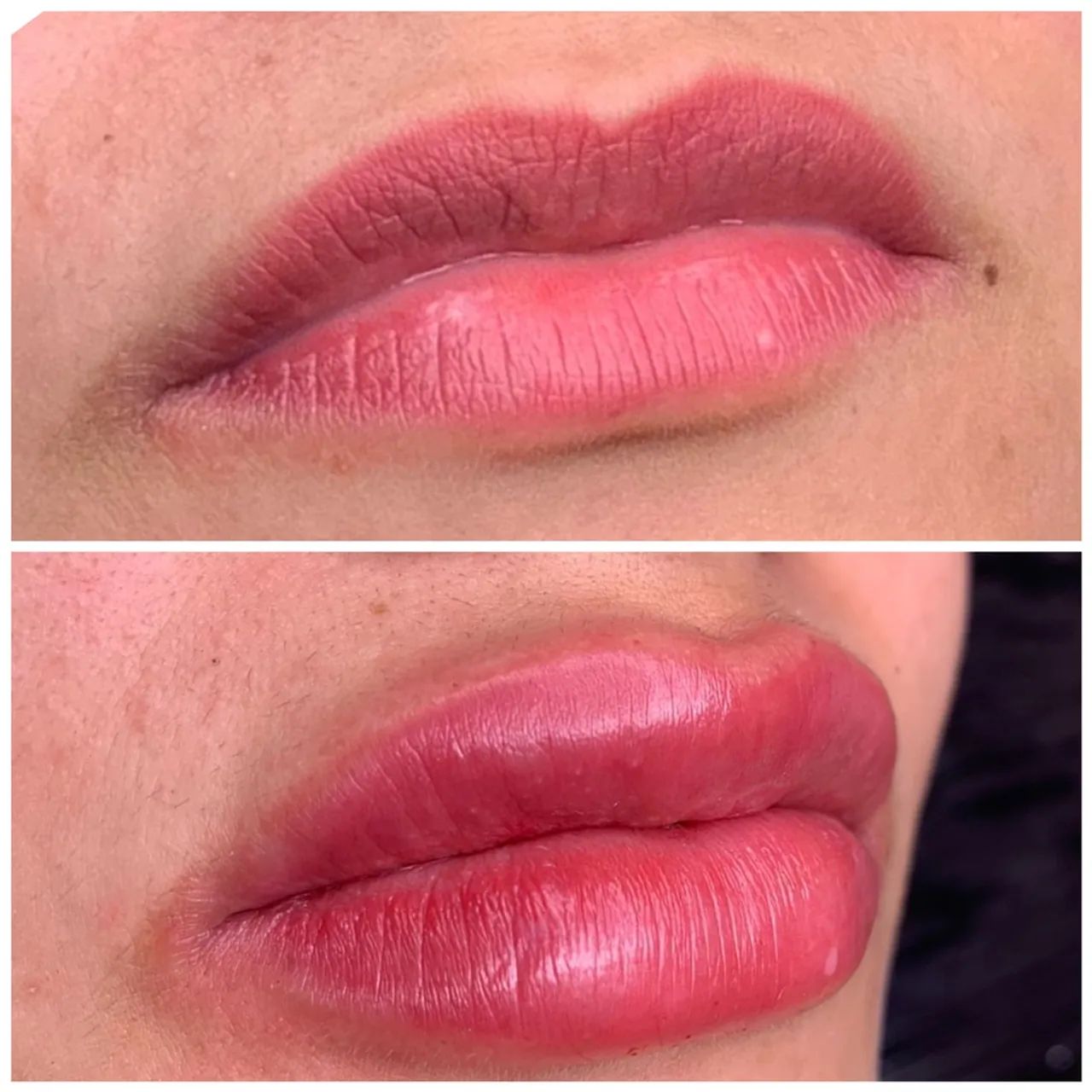 Estetica Preenchimento Labial  - Foto 2