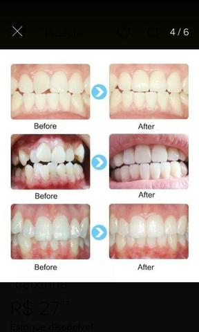 Silicone alinha os dentes Bruxismo e anti ronco 3 em 1 - Foto 4
