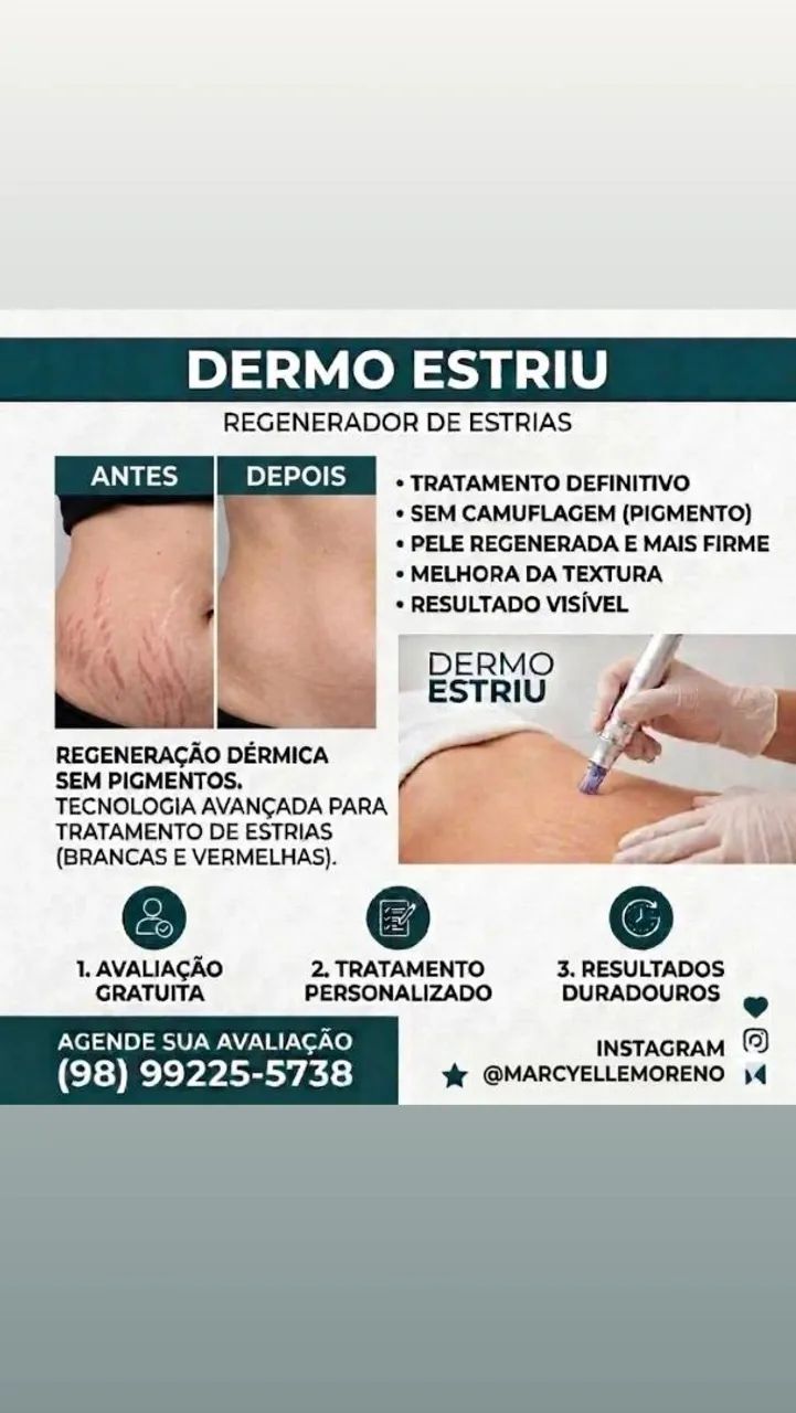 Tratamento definitivo de estrias R$150 a área.