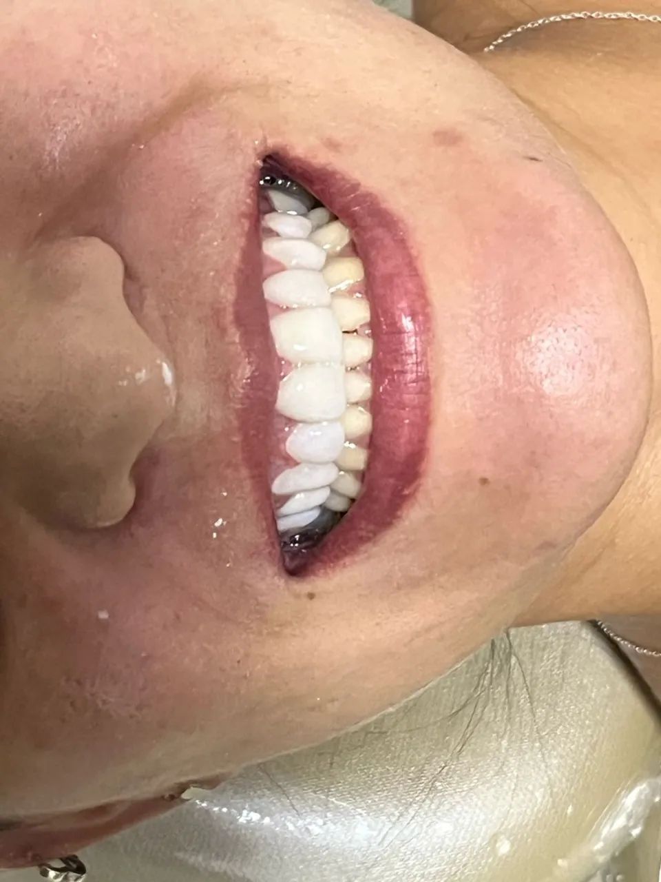 Facetas de Resina PROMOÇÃO  - Foto 3