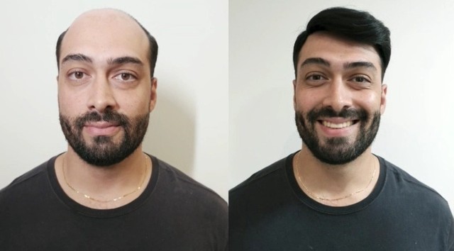 Prótese Capilar Masculina - Instalada