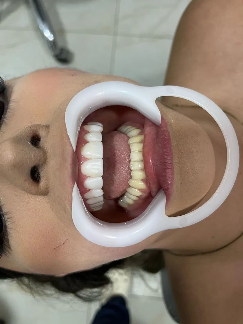 Facetas de Resina PROMOÇÃO  - Foto 4