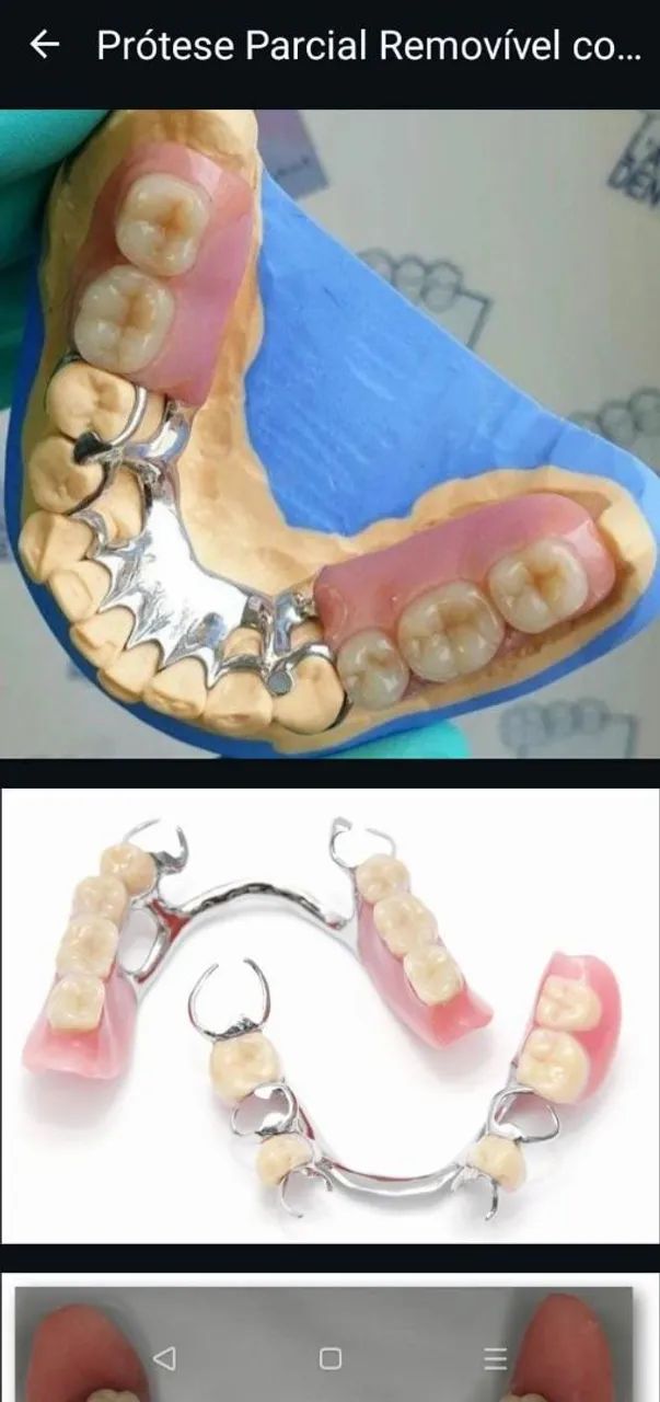 Dente Prótese Dentária  - Foto 3
