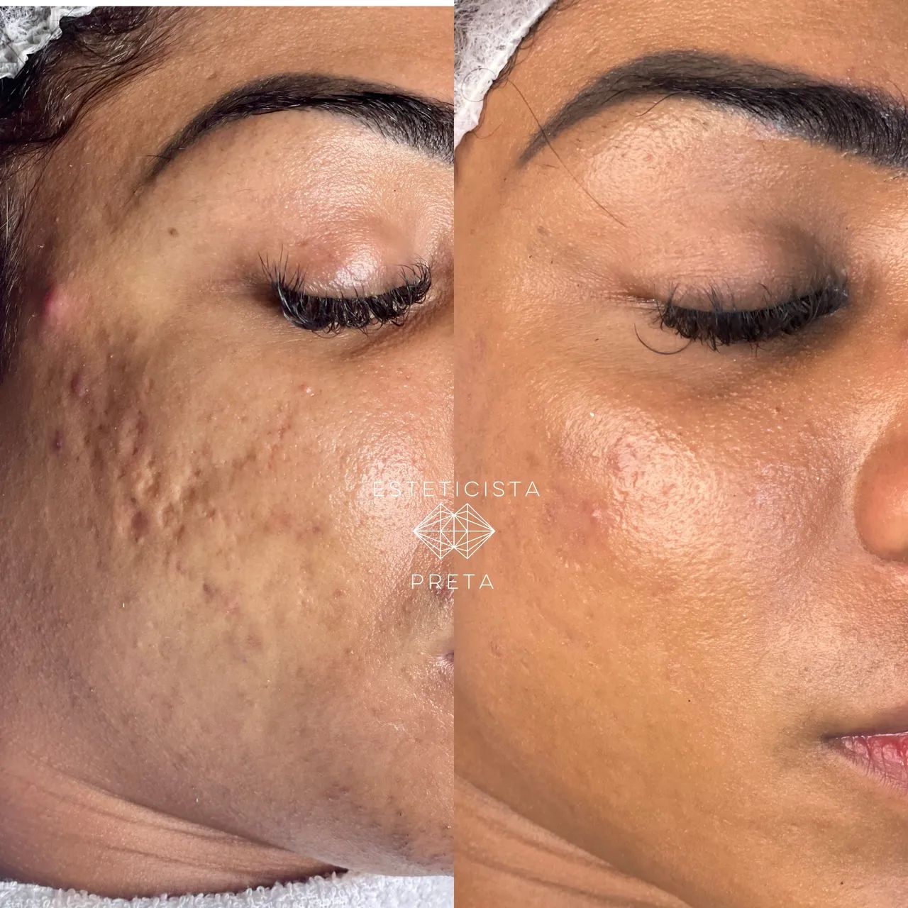 TRATAMENTO DE ACNE E CICATRIZ DE ACNE