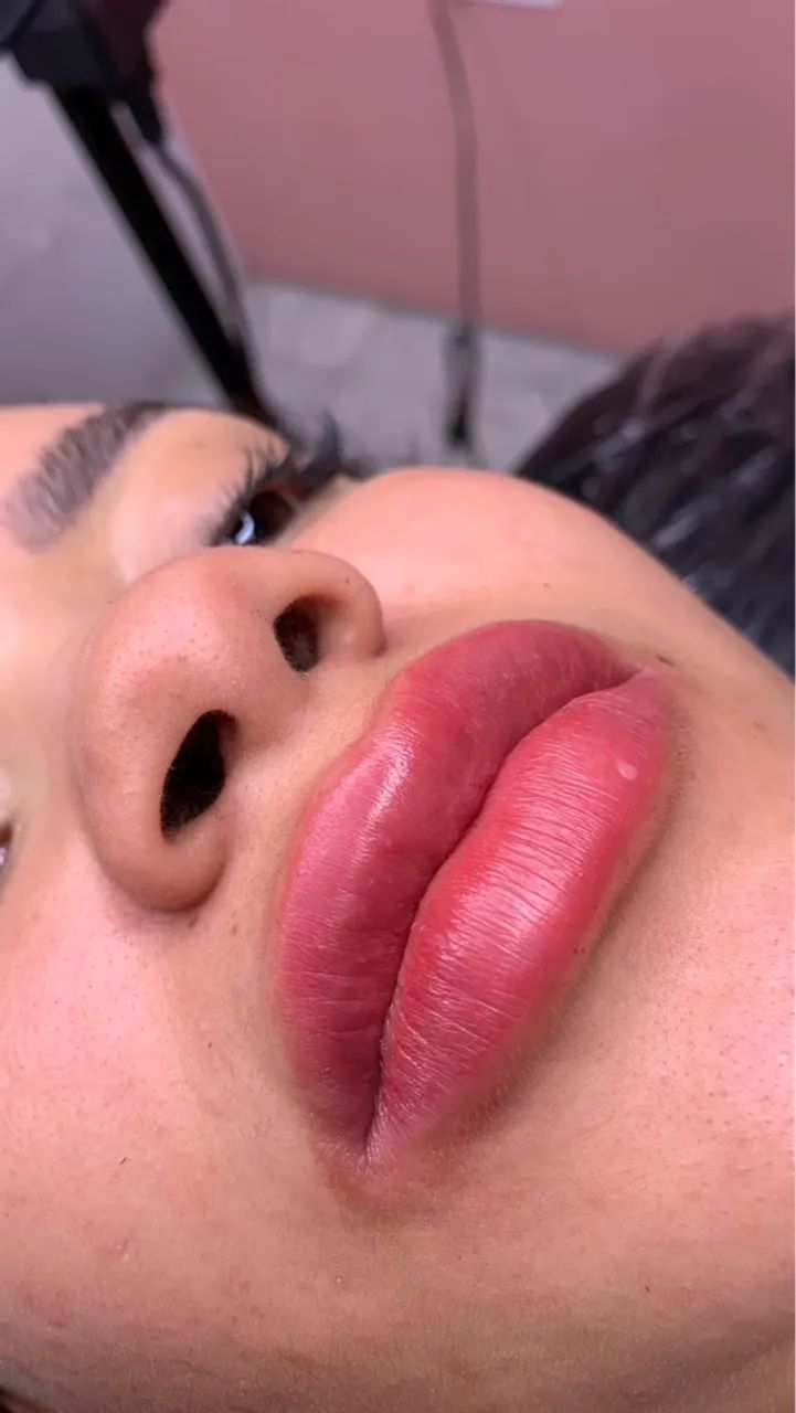 Estetica Preenchimento Labial  - Foto 3