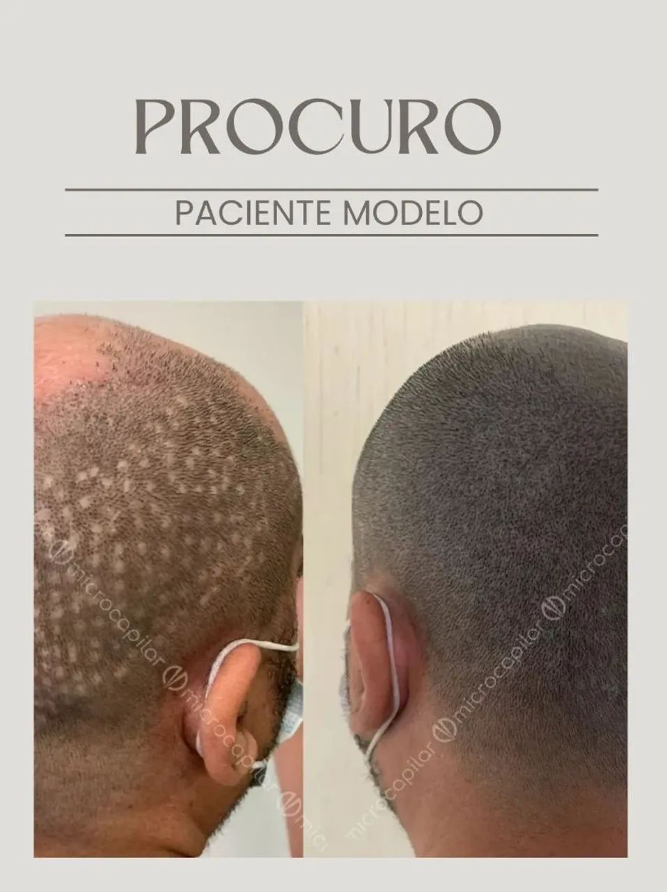 Modelo para micropigmentação Capilar - Foto 2