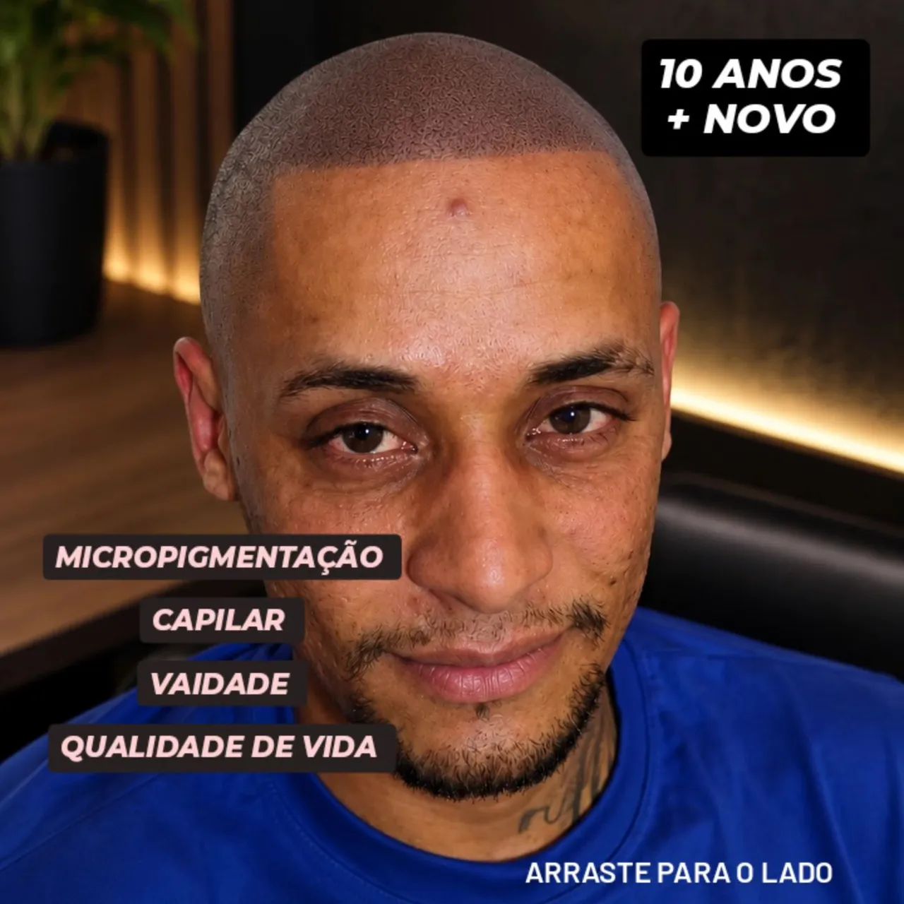 Micropigmentação Capilar  - Foto 2