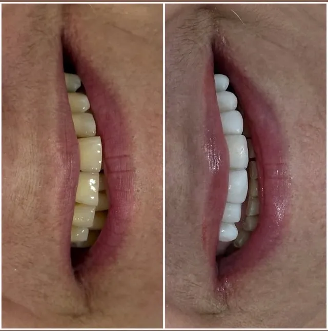 Facetas dentárias