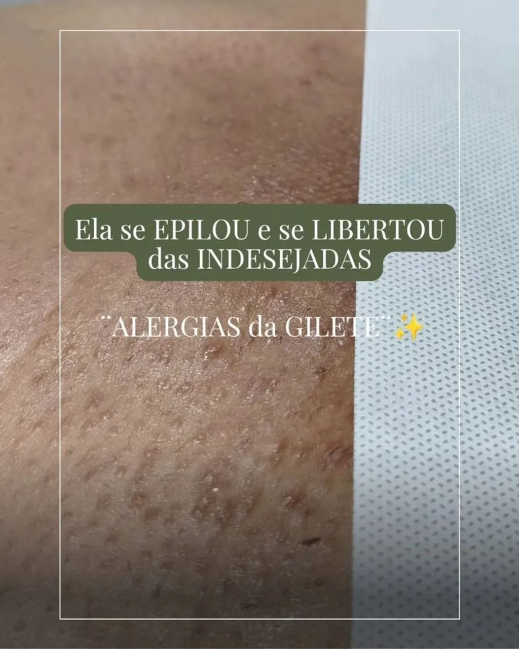 Depilação corporal c cera - Foto 2