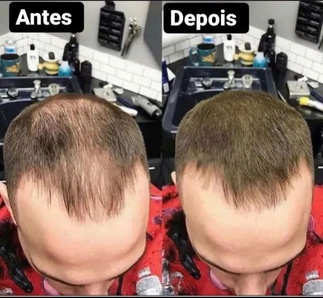 Queda de cabelo - Foto 3