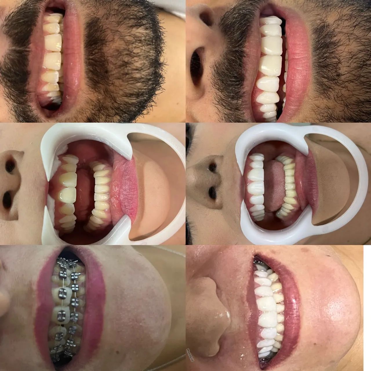 Facetas de Resina PROMOÇÃO 