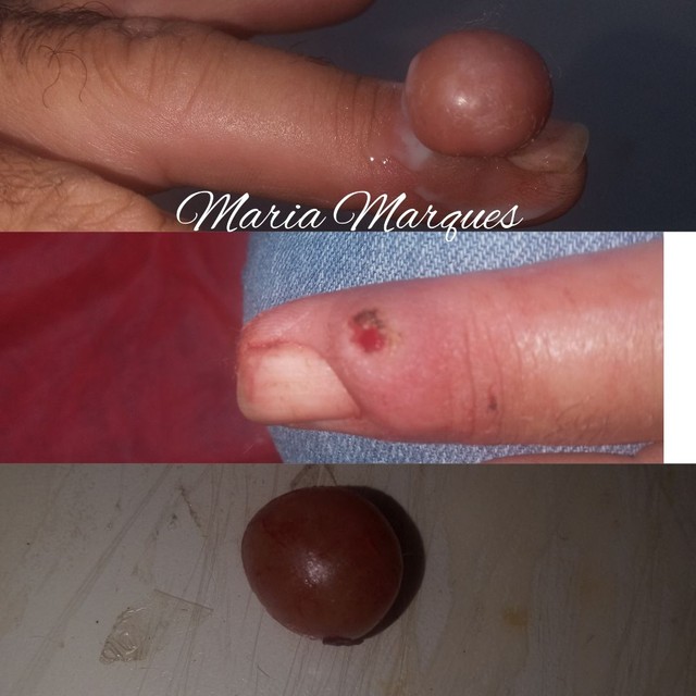 Remoção de verrugas ou queloides