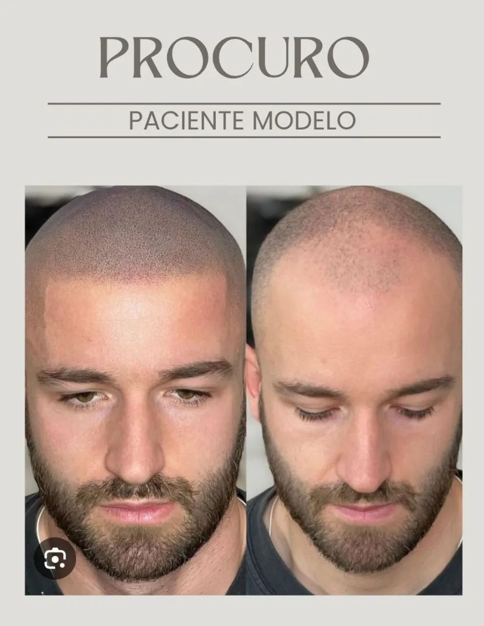 Modelo para micropigmentação Capilar - Foto 3