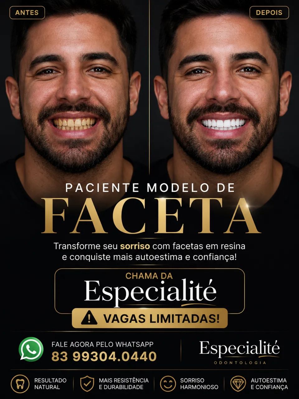 Dentes mais brancos e bonitos com Facetas de Resina  - Foto 4