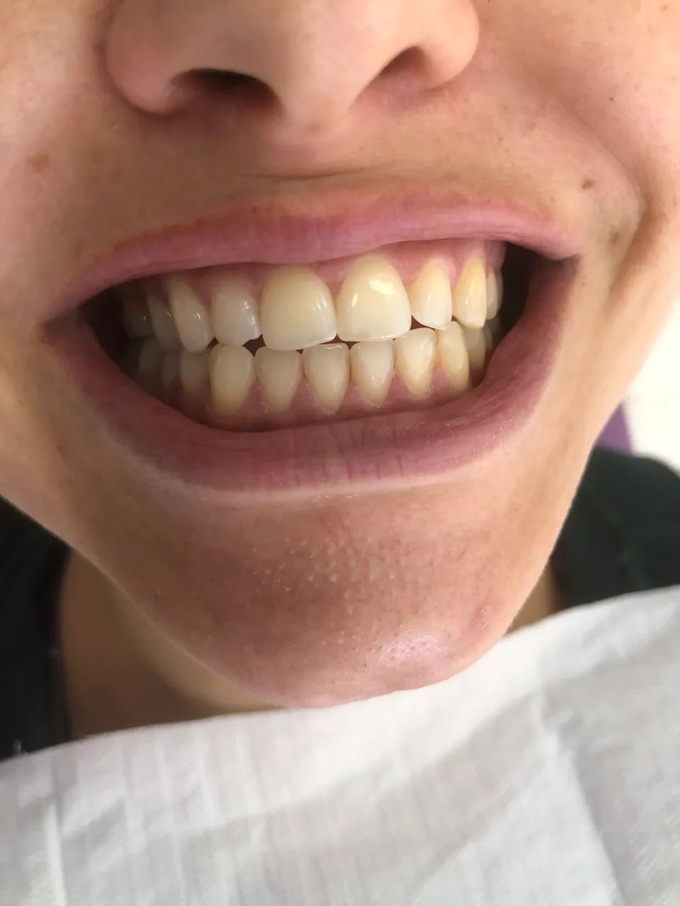 Dentista Clareamento no Consultório  - Foto 3