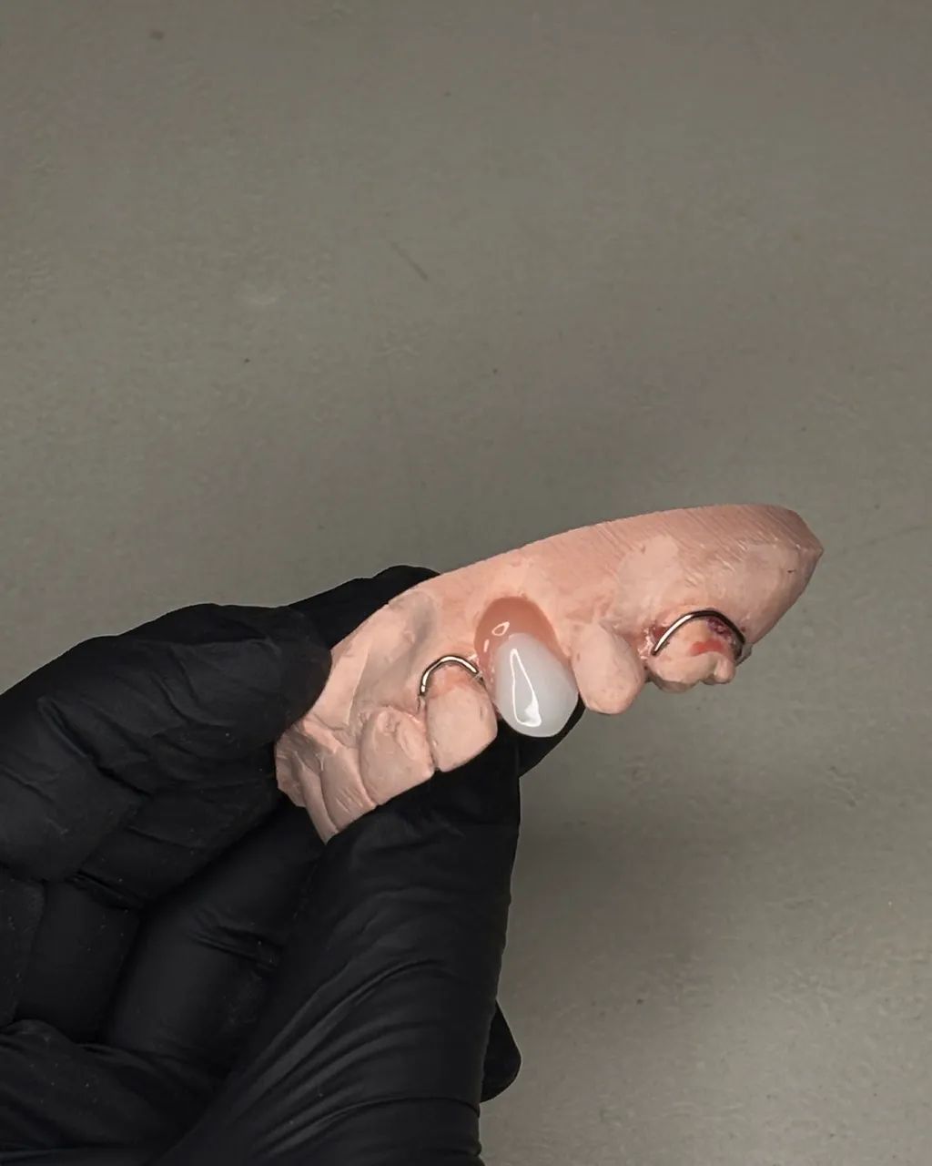 PPR acrílica prótese dentária acrílica 