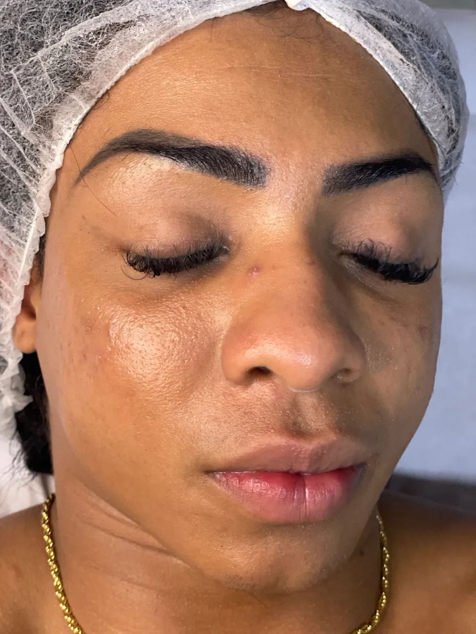 TRATAMENTO DE ACNE E CICATRIZ DE ACNE - Foto 2