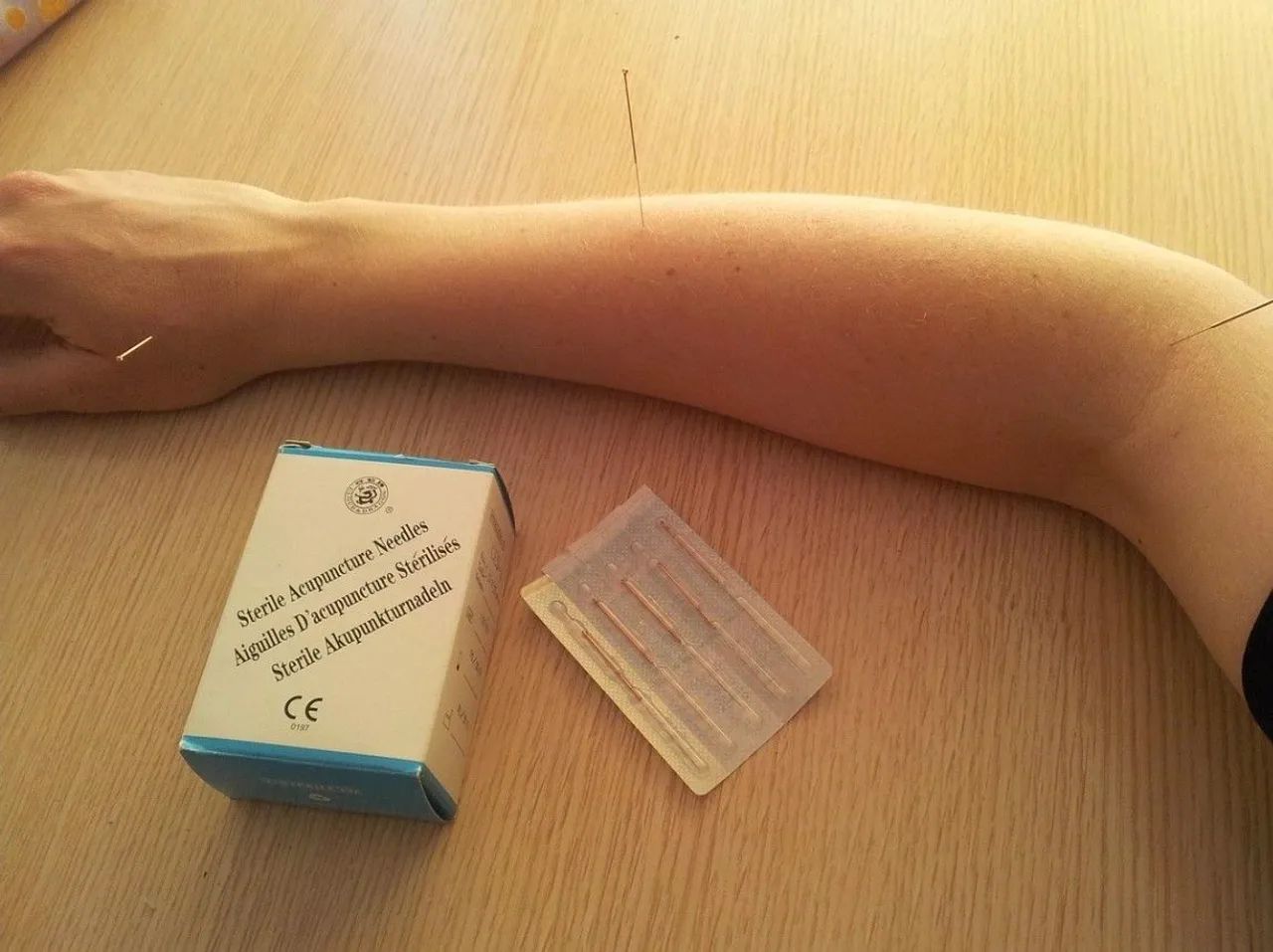 Acupuntura e outras terapias  - Foto 2