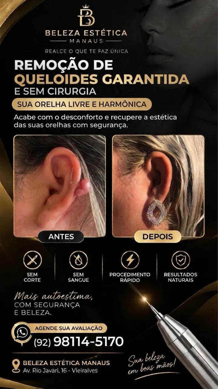 Remoção de queloides com laser 