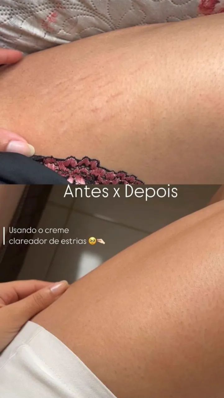 Creme Lummina Gest 200g Para Estrias E Celulite - Foto 3
