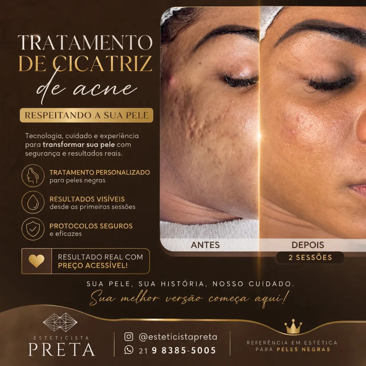 TRATAMENTO DE ACNE E CICATRIZ DE ACNE - Foto 3