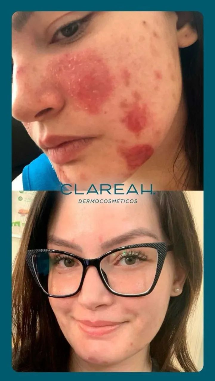 Sérum Clareah - clareia manchas e melasmas  - Foto 4