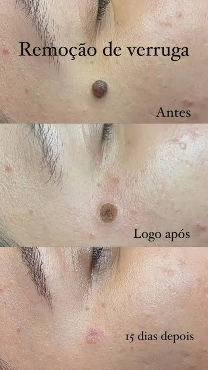 Remoção de Sinais e Verrugas