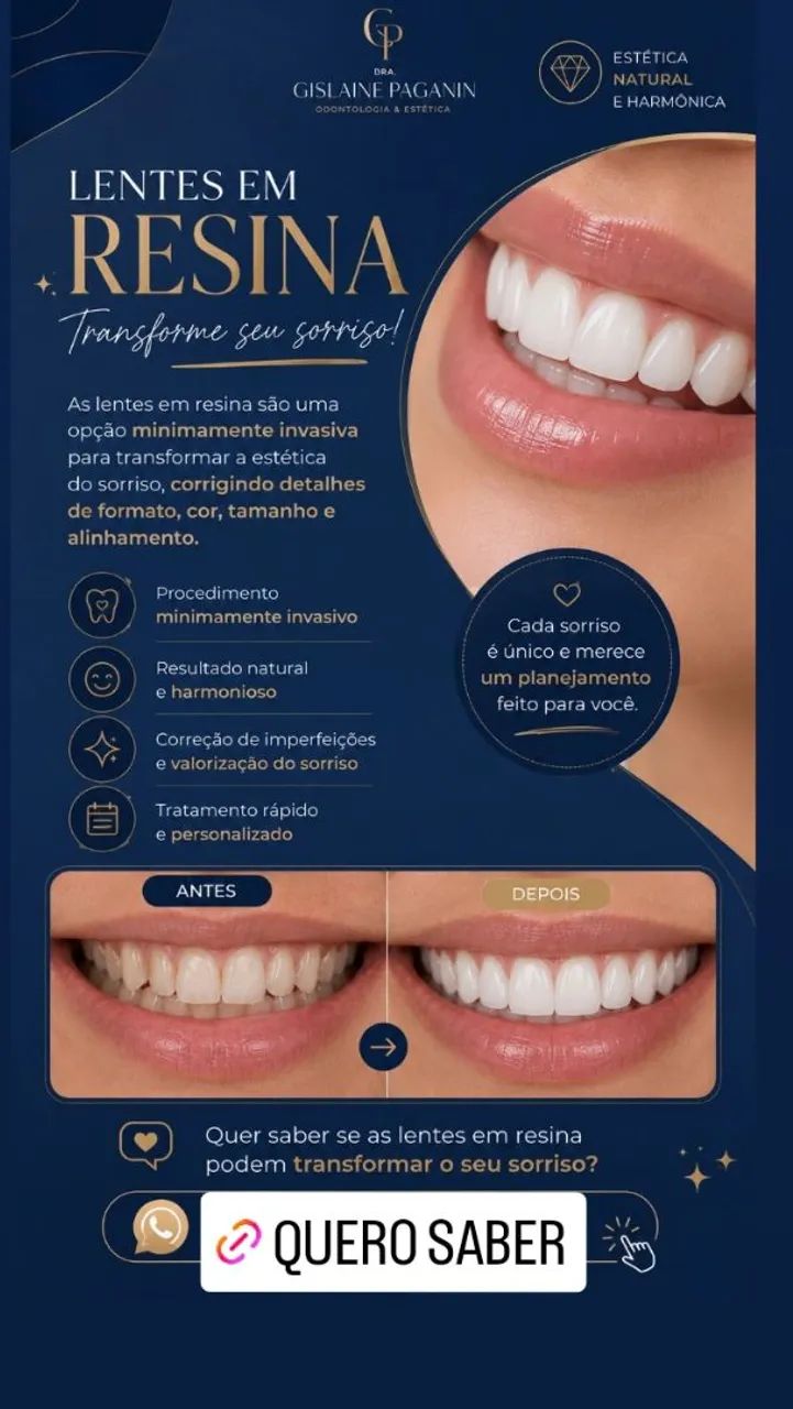 Lentes em resina | Transforme seu sorriso