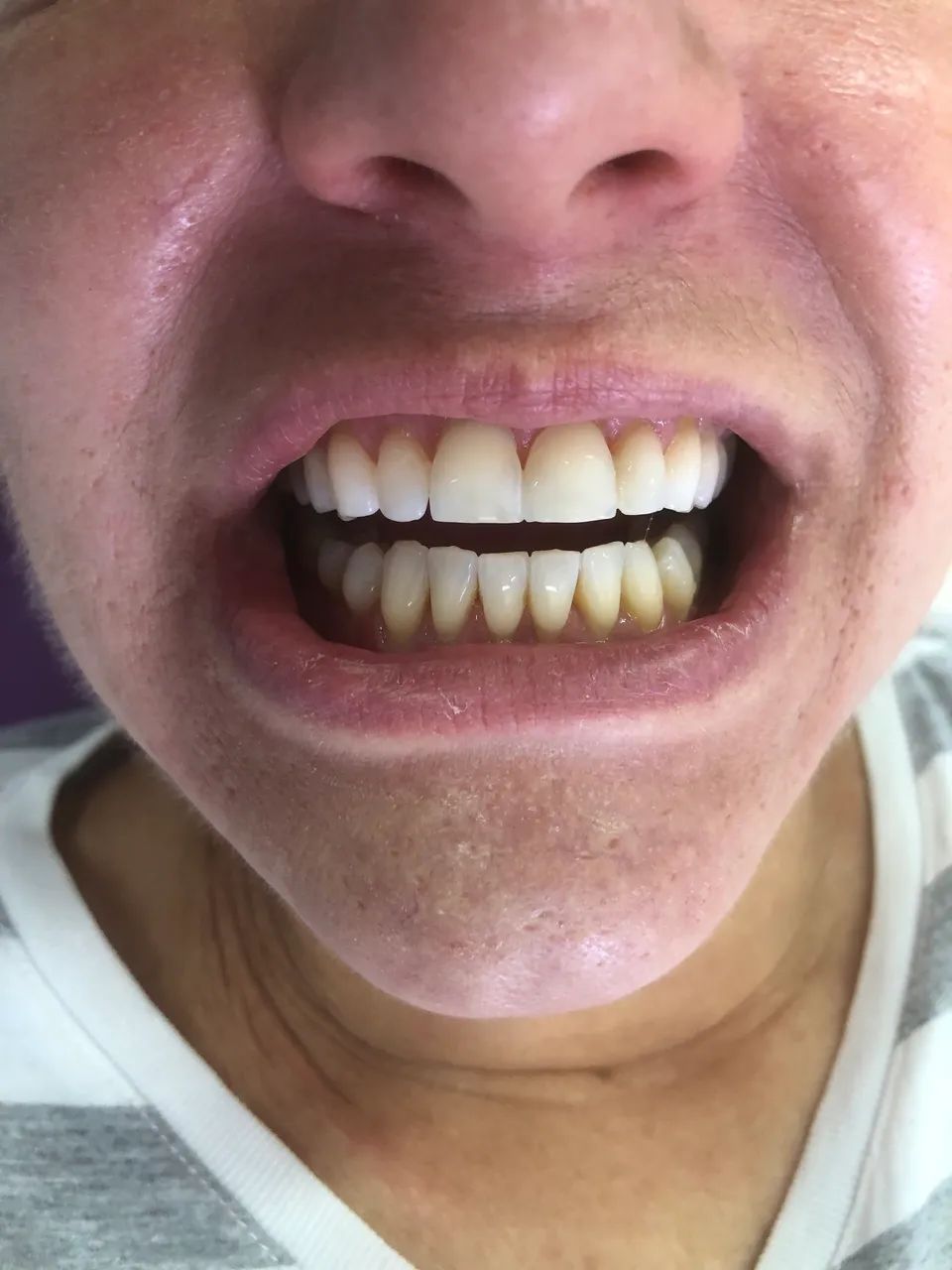 Dentista Clareamento no Consultório  - Foto 4