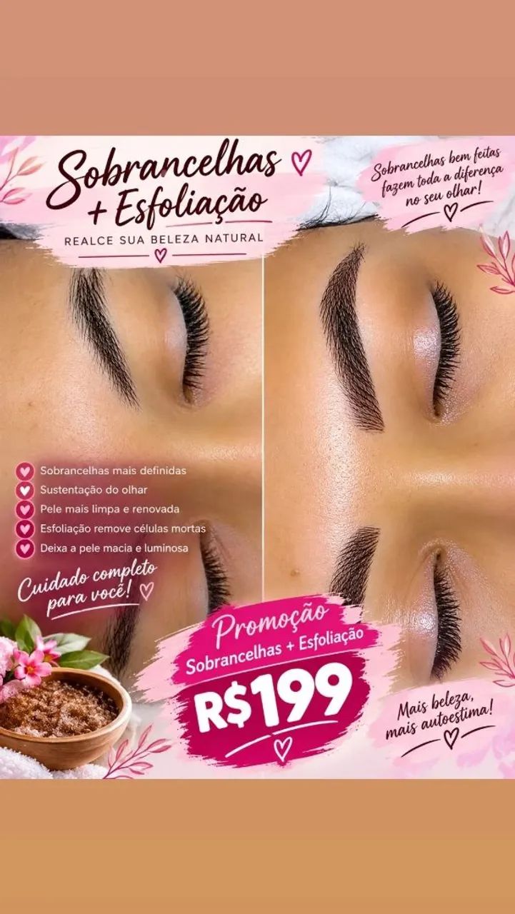 Retirada de sinais e micro micropigmentação de sobrancelhas - Foto 2