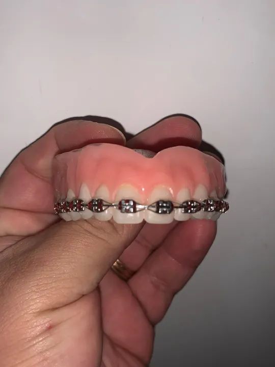 Prótese dentária a partir de 200 reais  - Foto 4