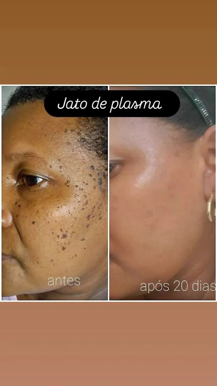 Retirada de sinais e micro micropigmentação de sobrancelhas