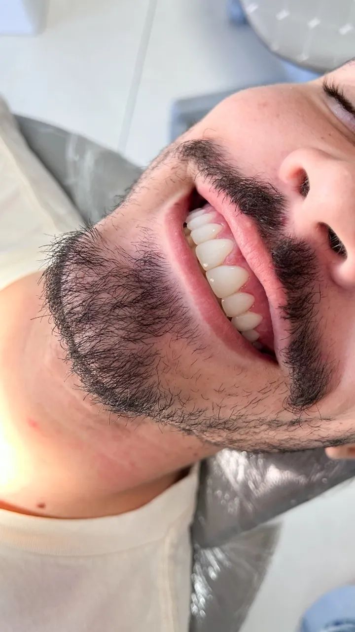 Facetas em Resina em Fortaleza e Caucaia 