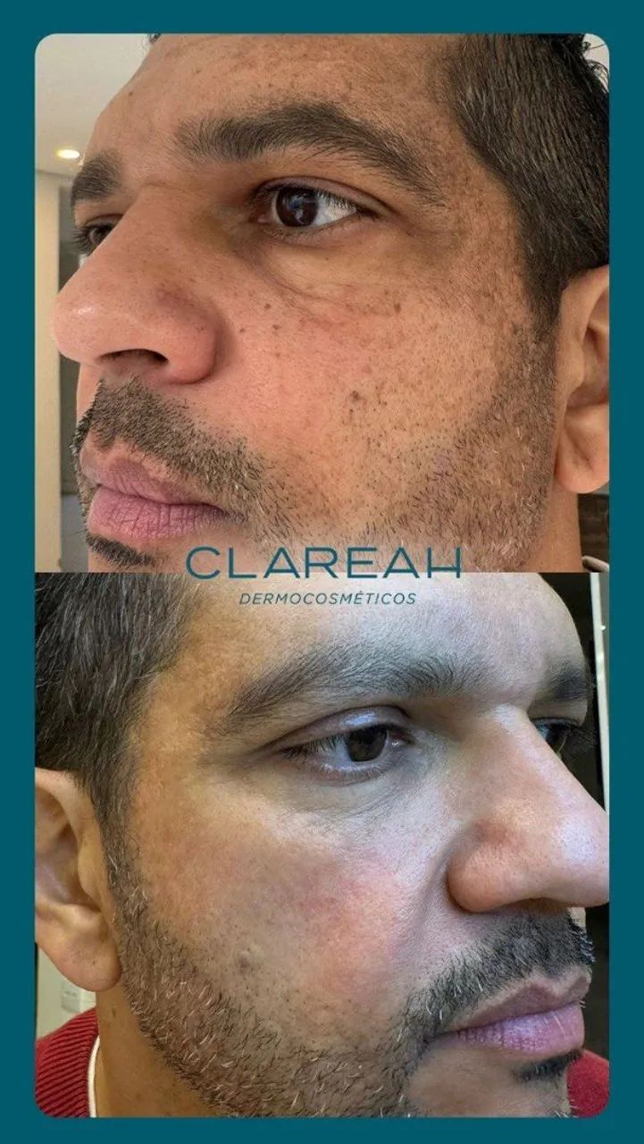 Sérum Clareah - clareia manchas e melasmas  - Foto 5