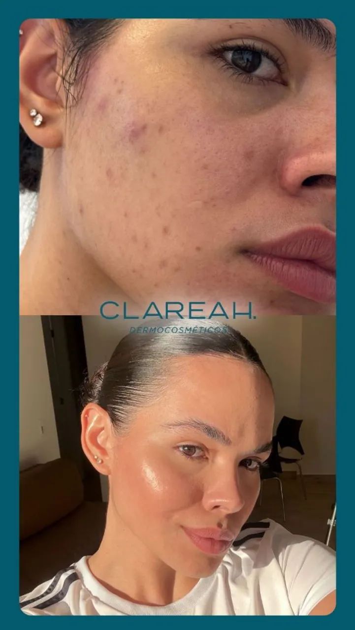 Sérum Clareah - clareia manchas e melasmas  - Foto 6
