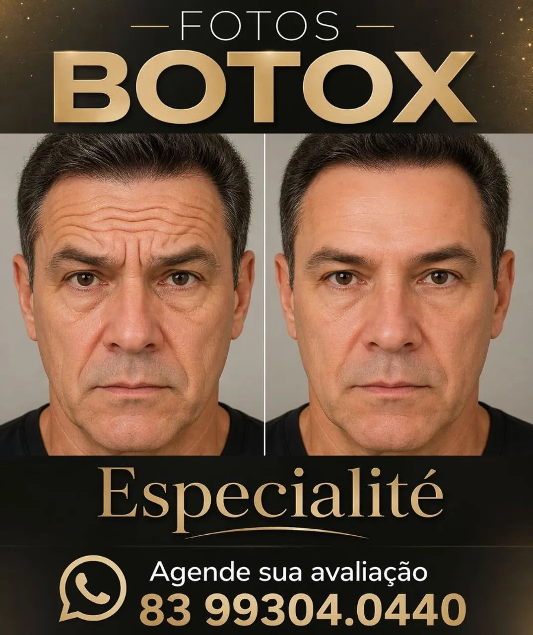 Rejuvenesça seu rosto com Botox e resultados naturais - Foto 2