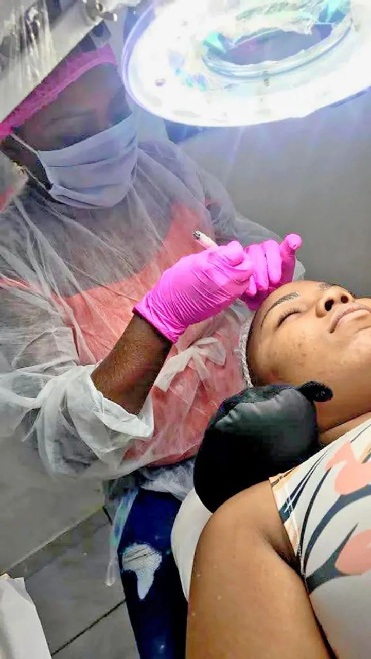 Retirada de sinais e micro micropigmentação de sobrancelhas - Foto 3