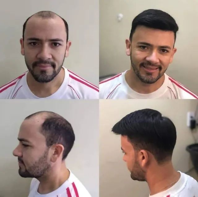 Prótese Capilar masculina  - Foto 2