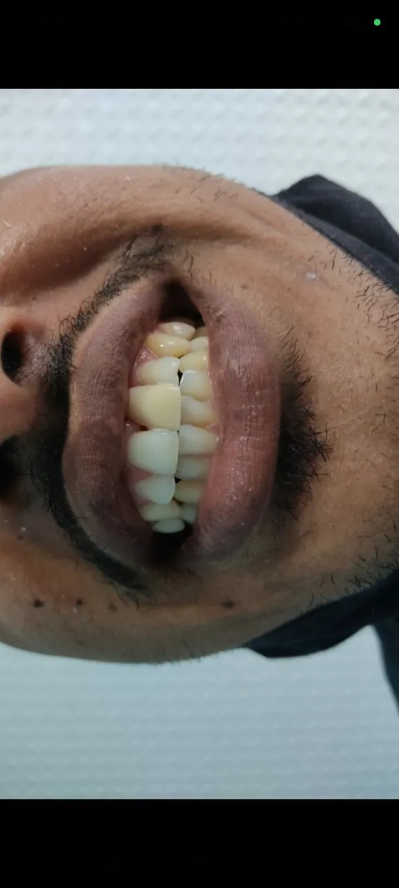 Dentadura -roches - prótese de náilon. Provisório 
