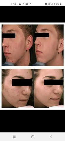 Acido Glicolico -Hinode  - Foto 5