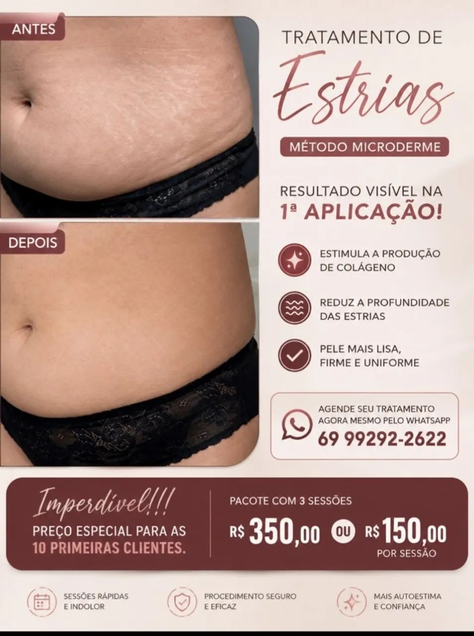 Tratamento zero estrias