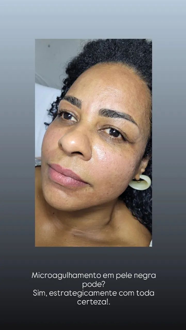 Microagulhamento  - Foto 2