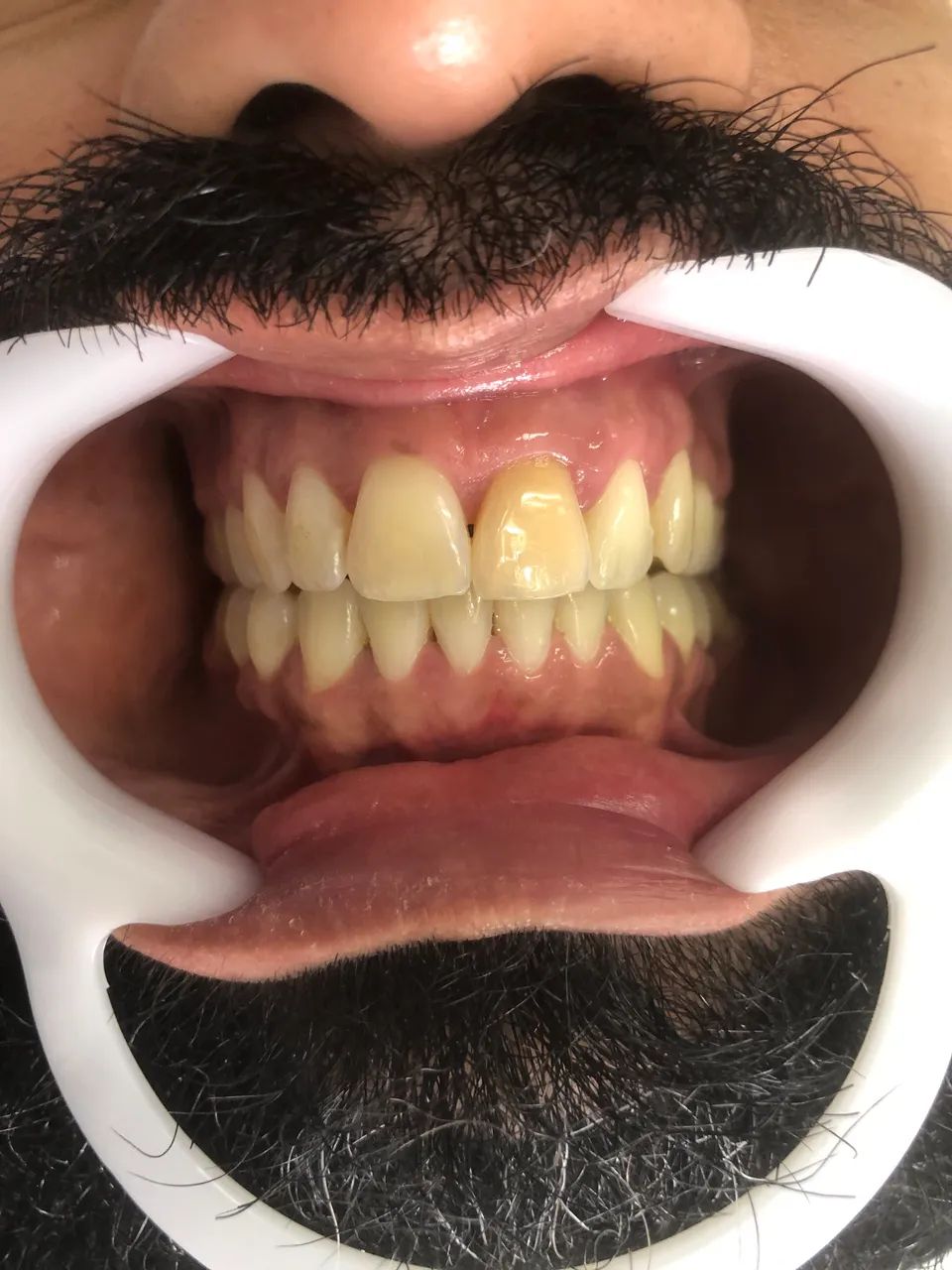 Dentista Clareamento no Consultório  - Foto 5